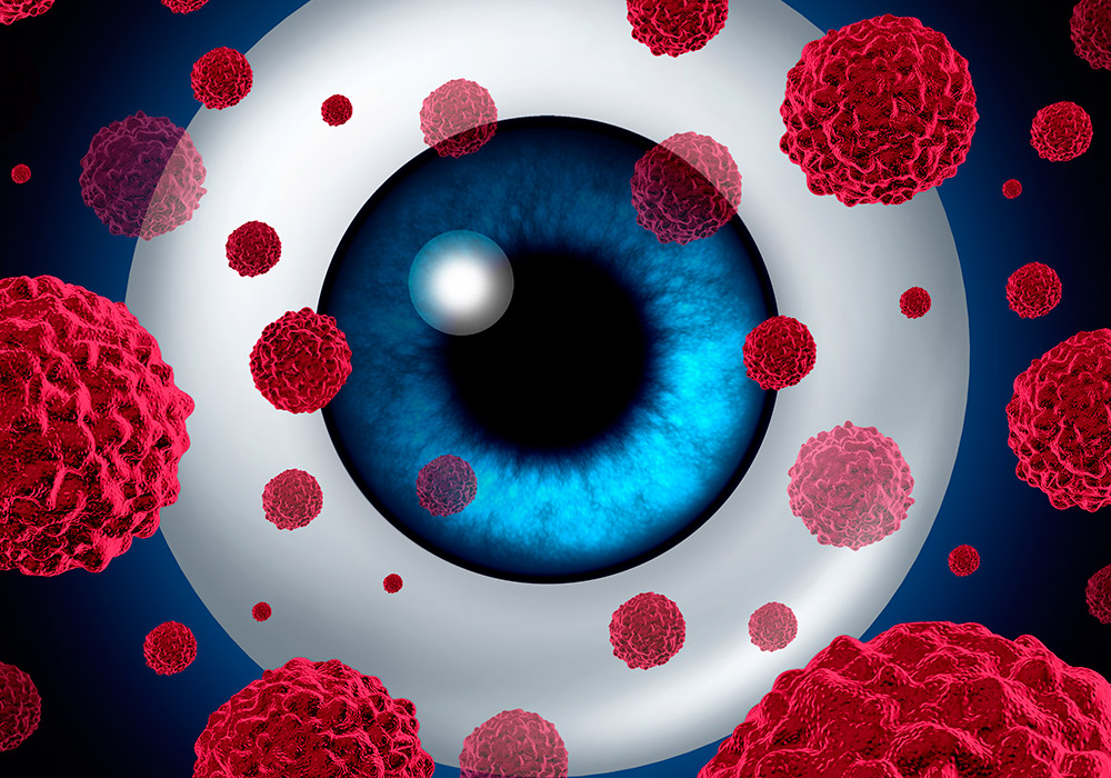 Oncología Ocular - Cáncer Ocular